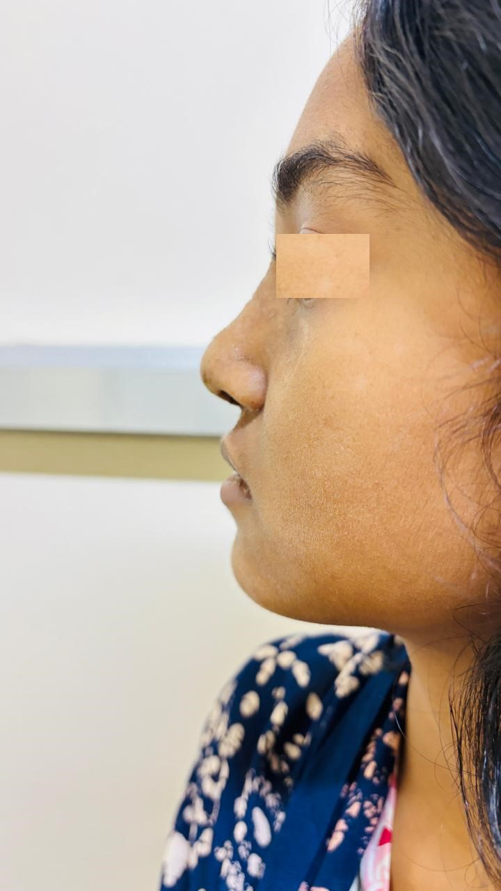 Post-Traumatic Nasal Deformity - After Surgery
