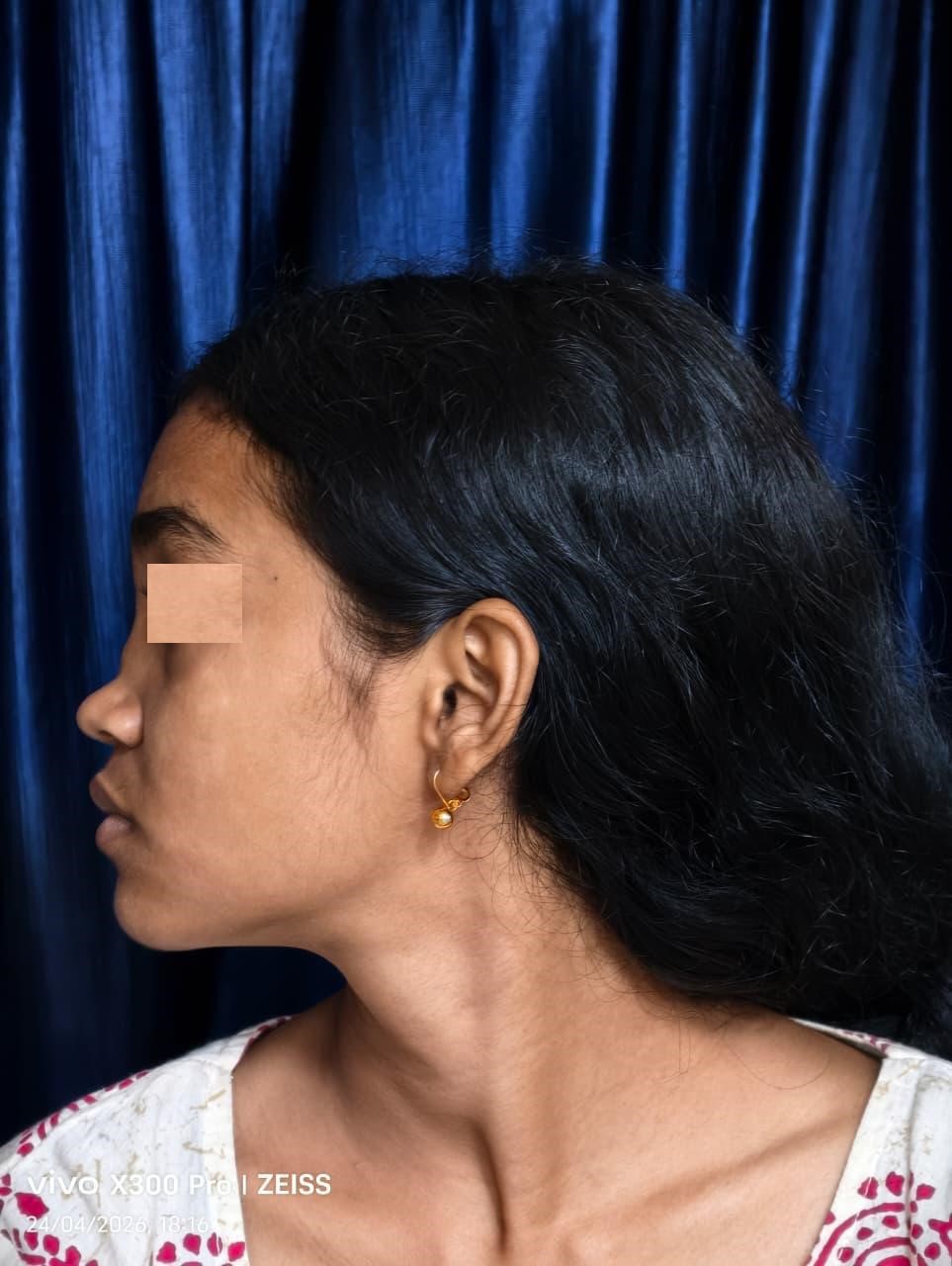 Post-Traumatic Nasal Deformity - Before Surgery