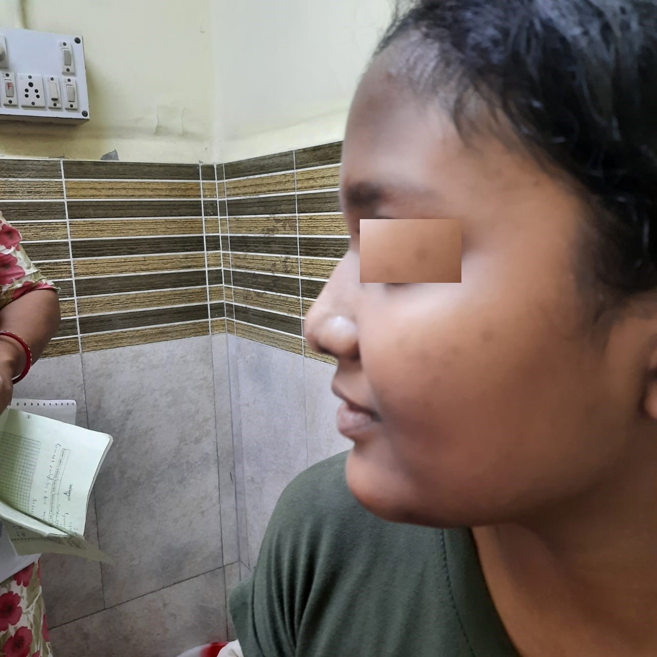 Severe Nasal Septum Deviation - After Surgery
