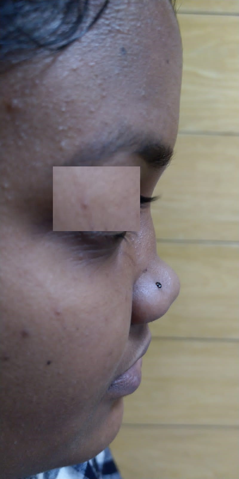 Severe Nasal Septum Deviation - Before Surgery