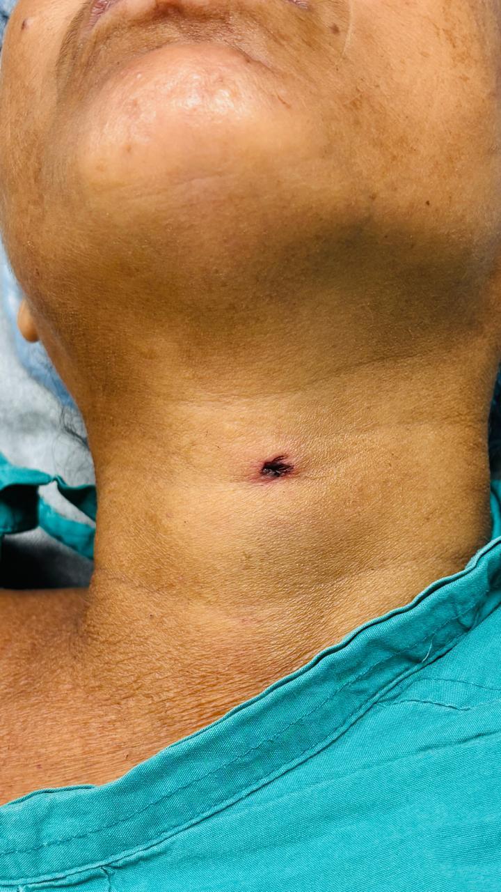 Neck Swelling - Before Surgery