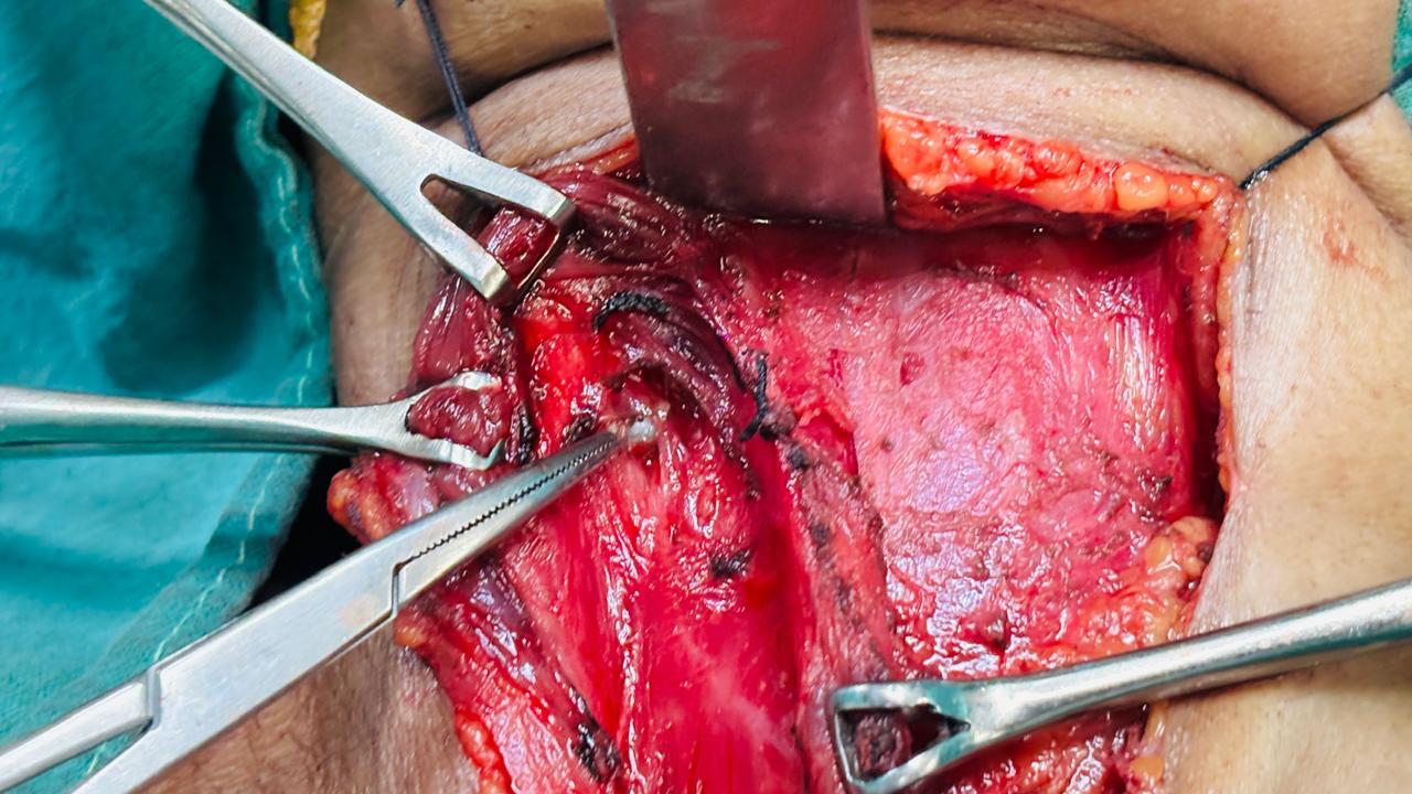 Intra-operative photo showing surgical exploration of penetrating neck injury