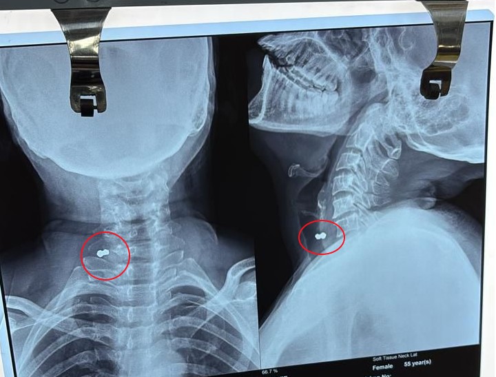 Submandibular Mass - Diagnostic X-Ray Imaging